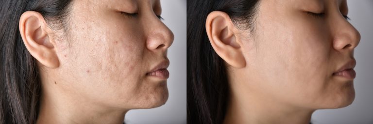 acne scar treatment in ontario