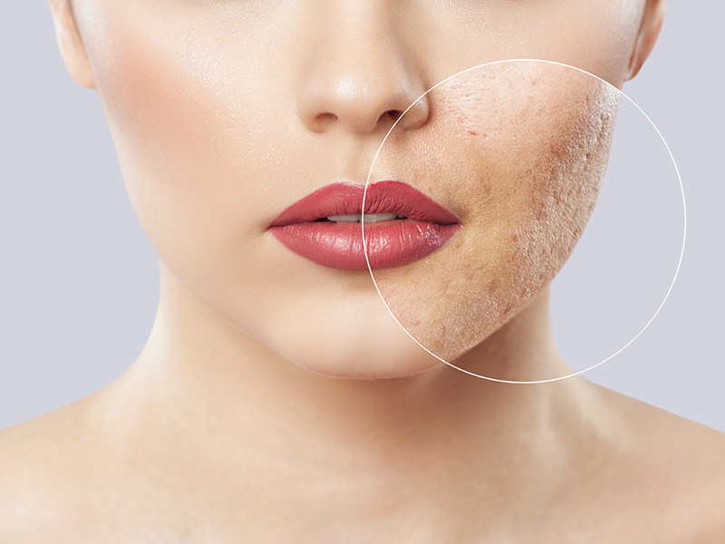 Facial Scar Treatment