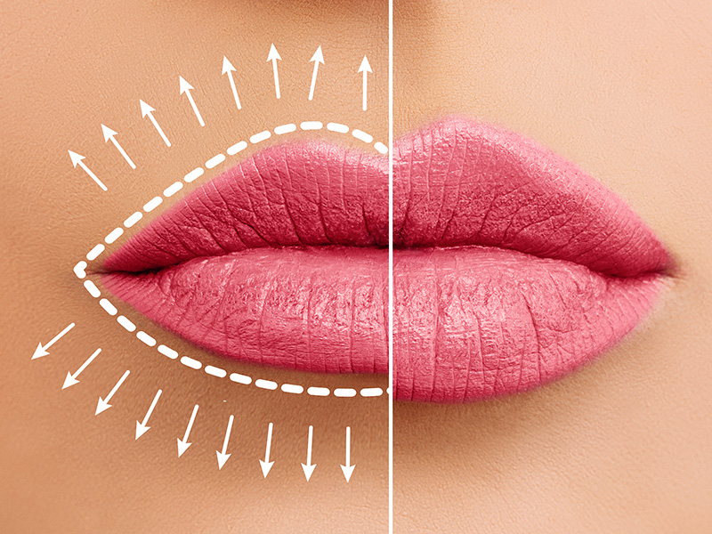 Lip Augmentation