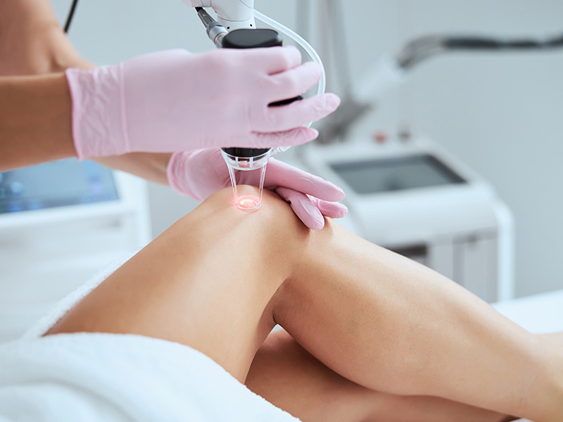 Spider Vein Treatment